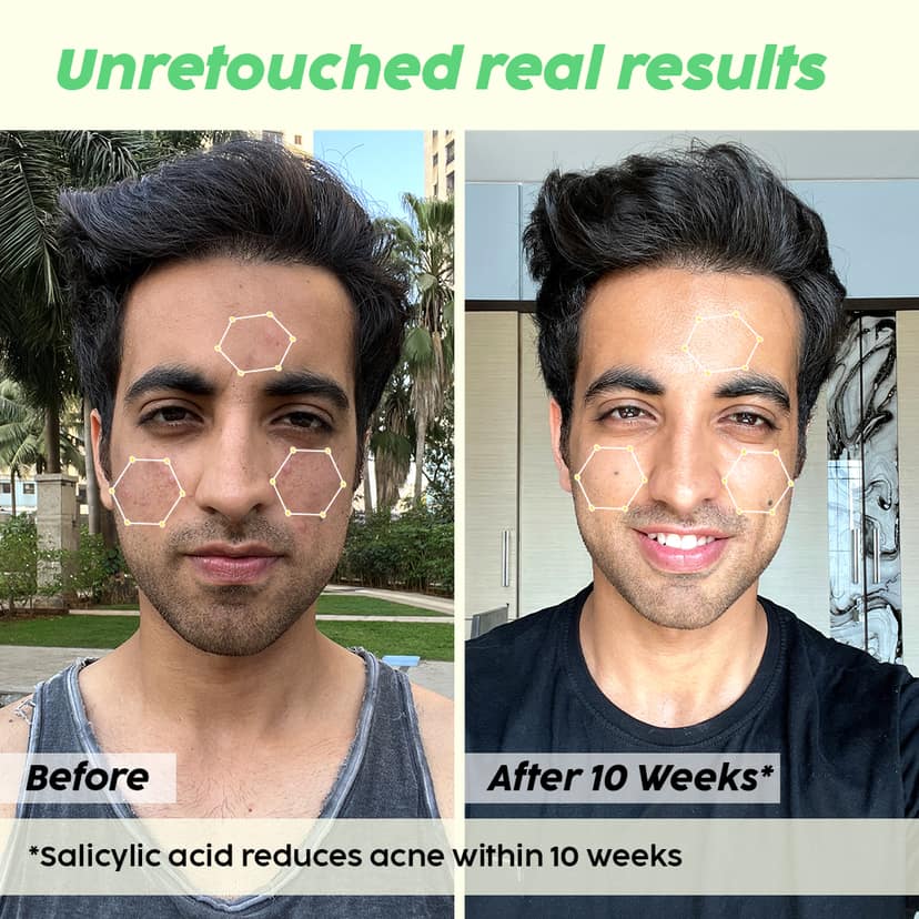 Jamun Salicylic Acid Cleanser Gel For Active Acne | Acne Prone Skin __Expert Pack__ view 3