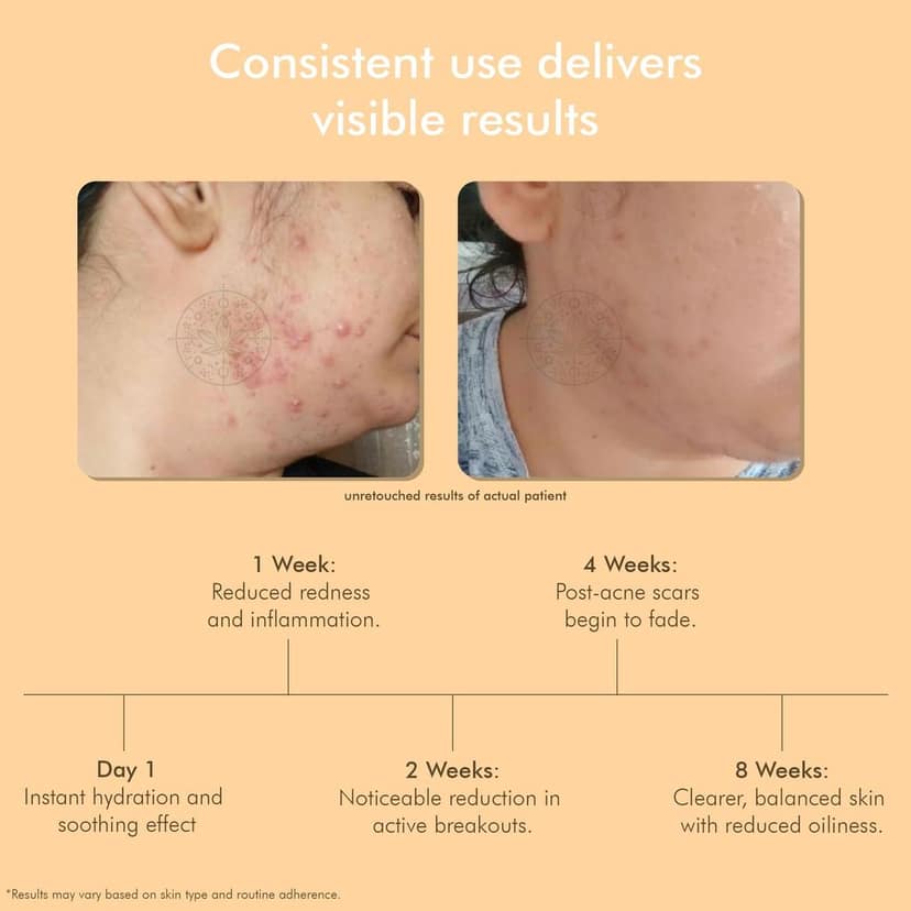 Vedicderm Nano Gold Acne Defence Cream With Curcumin Extract & Rose Hydrosol I Anti-Acne, Anti-Inflammatory Face Cream for Clear & Healthy Skin I 50g view 7