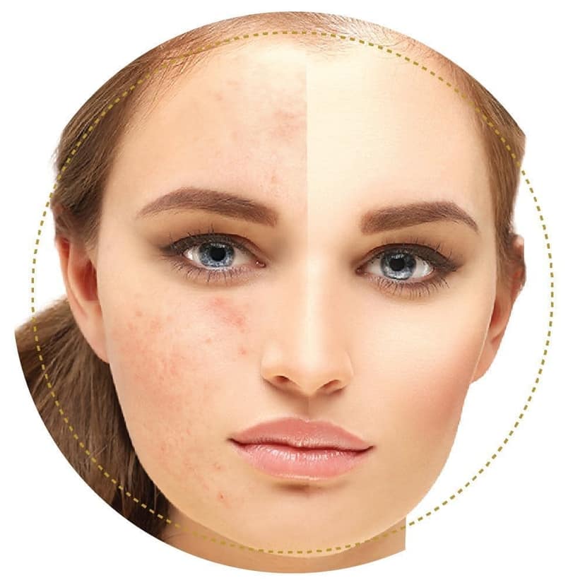 Papenglow: Face Pack For Oily Skin With Papaya Extract 75Gm. view 4