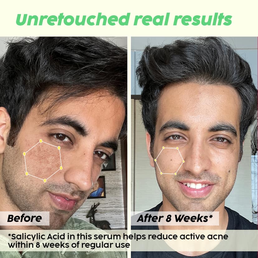 Jamun 2% Salicylic Acid Exfoliating Face Serum | For Active Acne & Blackheads __Starter Pack__ view 4