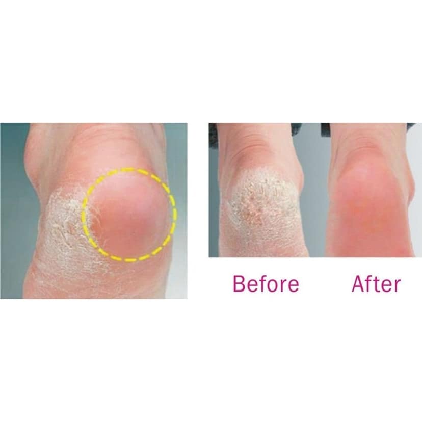 Babila Callus Remover (Rechargeable)CR-E01 view 3