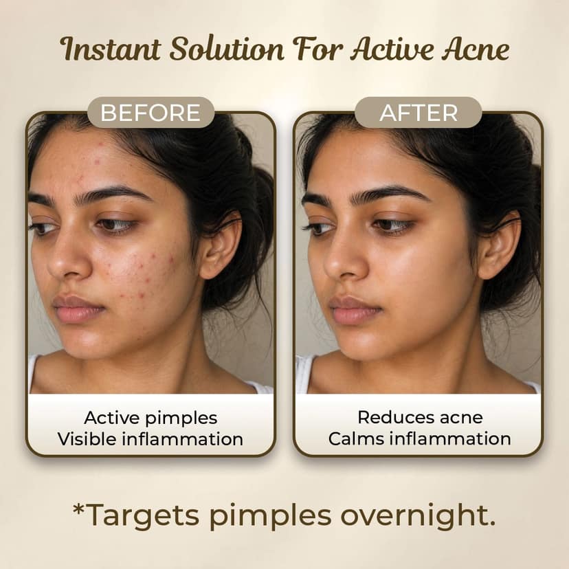 Sanfe Face Acne Clearing Glo Patch - 12 Pcs view 2