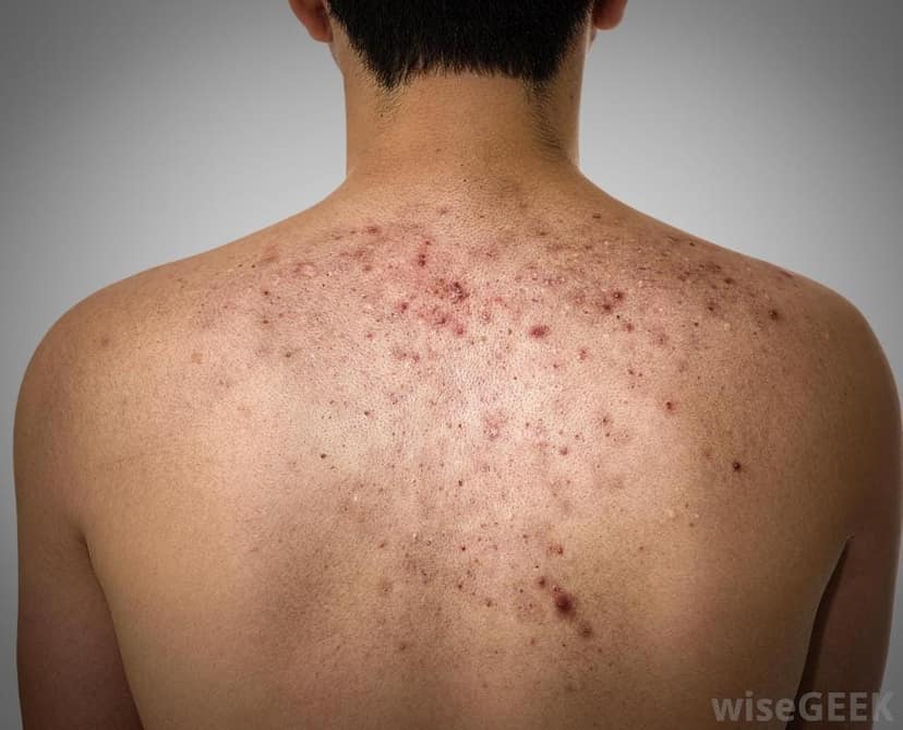 Skar Vanish Kit- Scar Pigmentation Kit (3 Months Pack) view 5