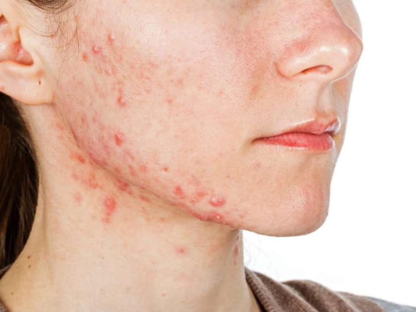 Skar Vanish Kit- Scar Pigmentation Kit (3 Months Pack) view 7