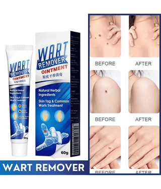 Wart Remover Cream For Blackhead remover, Pimple remover, Dead skin remover Cream