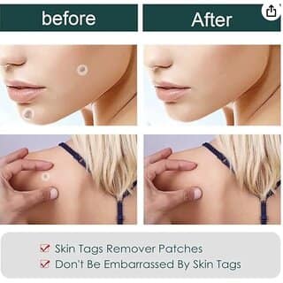 36 Pieces, Acne and Skin Tag Removal Patches, Absorbing Cover, Invisible, Blemish Spot, Hydrocolloid, Skin Treat view 2