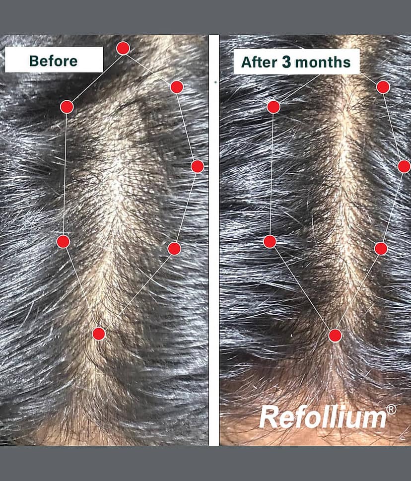 Refollium Anti Hair Fall Shampoo 150 ( Pack of 2 ) view 2