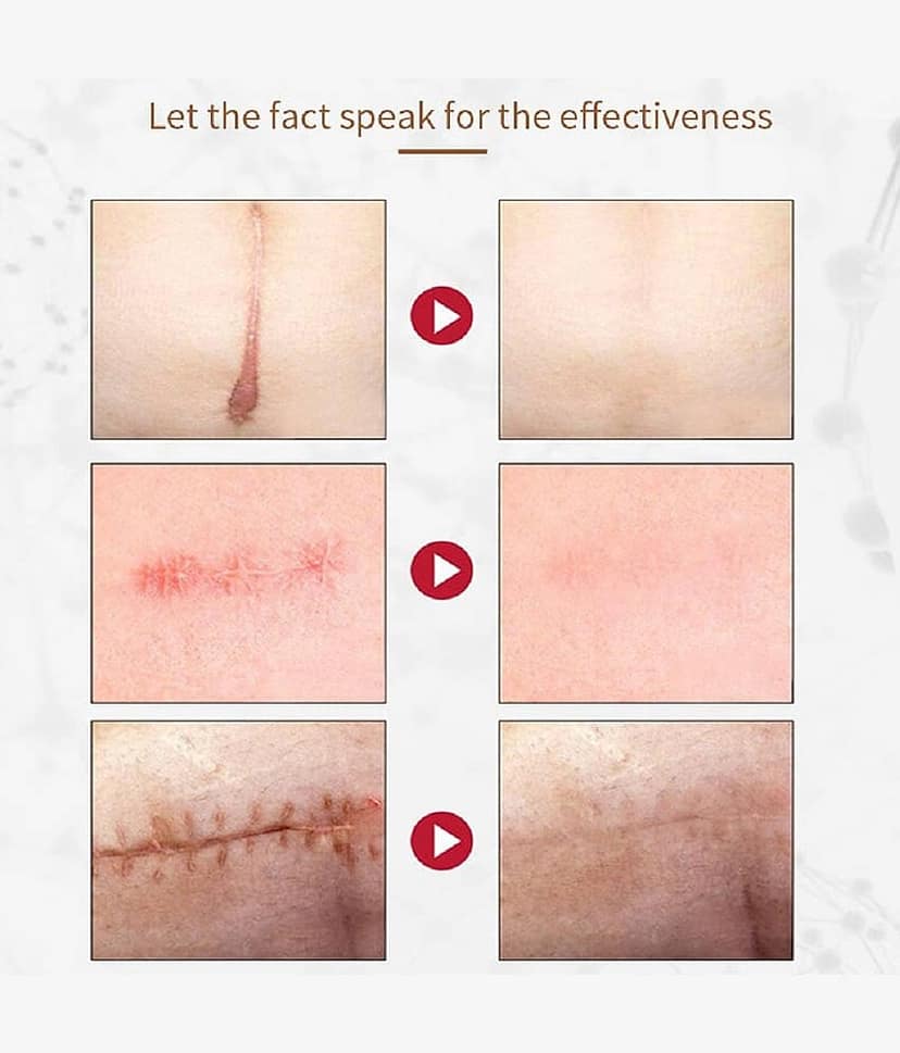 KURAIY Acne Face Cream Herbal Pimple Scar Removal Shrink Pore Oil Control Facial Cream view 2