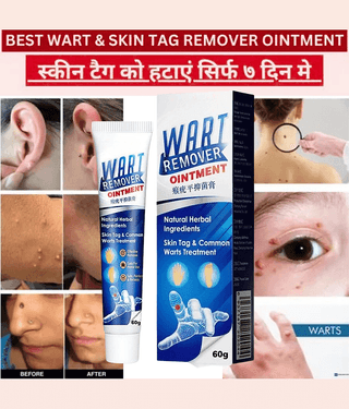 Massa Remover Cream for Warts Safely Painless Cream Skin Treatment