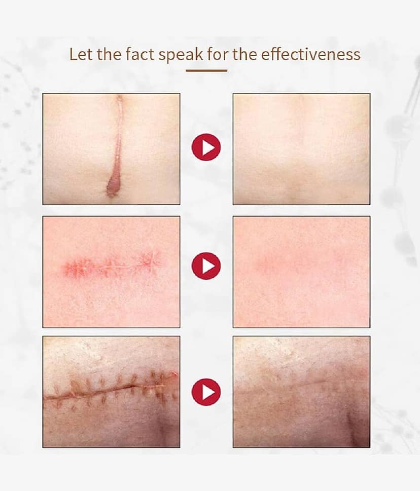 KURAIY Scar Removal Cream Repair Stretch Marks Burn Acne Scar Pack of 2 view 2