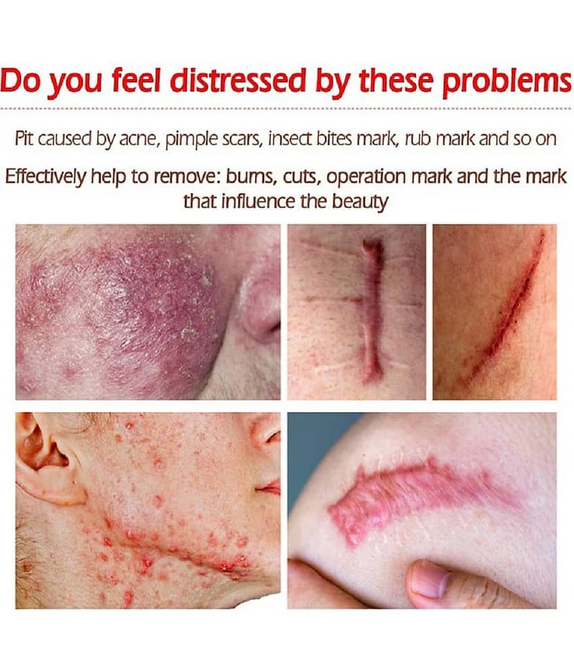 KURAIY Scar Removal Cream Gel Remove Acne Spots Treatment Pack of 3 view 2