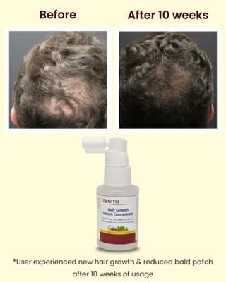 Zenith Trove Advanced Hair Growth Serum – 3% Redensyl, 4% Anagain, 2% Baicapil with Caffeine, Biotin & Rice Water | Hair Fall Control & Regrowth Booster | 30ml