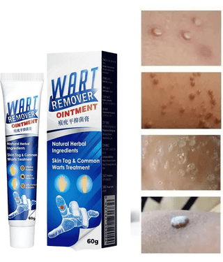 Massa Remover Cream for Warts Safely Painless Cream Skin Treatment