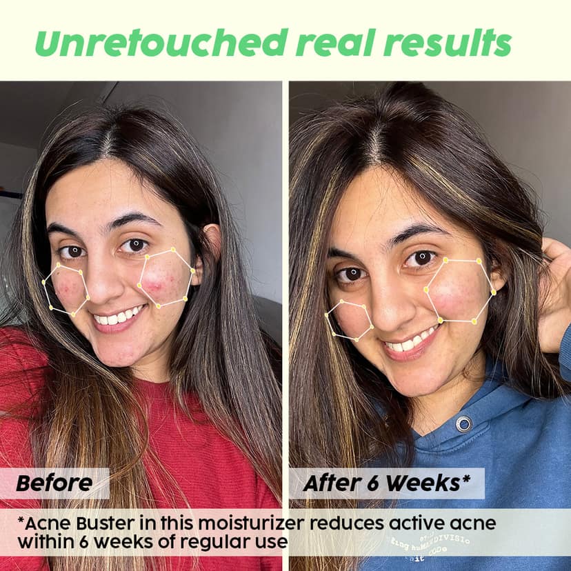 Jamun 2% Salicylic Acid Exfoliating Face Serum | For Active Acne & Blackheads __Pro Pack__ view 3