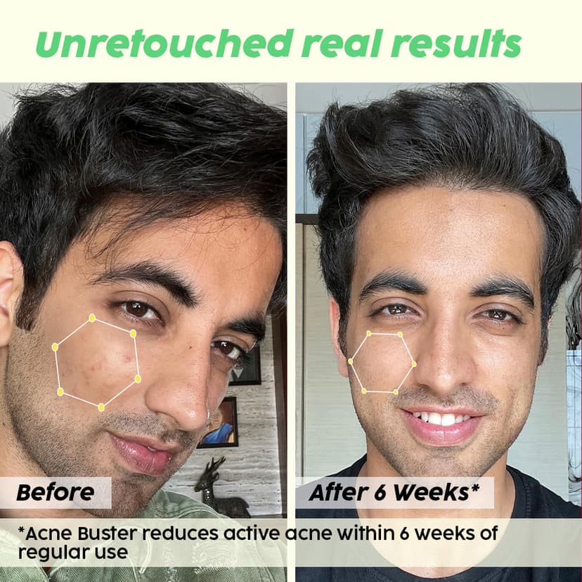 Jamun 2% Salicylic Acid Exfoliating Face Serum | For Active Acne & Blackheads __Pro Pack__ view 4