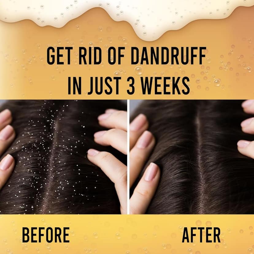 Beer Anti-Dandruff Shampoo | Removes Dandruff from Source | Helps with Itching, Irritation & Redness Accompanying Dandruff (1 Liter) view 5