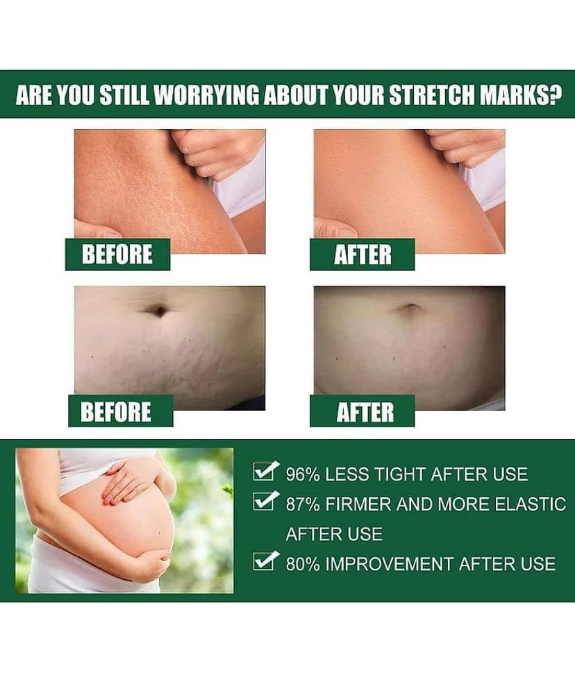 Kuraiy stretch Oil for Stretch Marks Removal Post Pregnancy stretch mark cream oil (50 ml) view 2