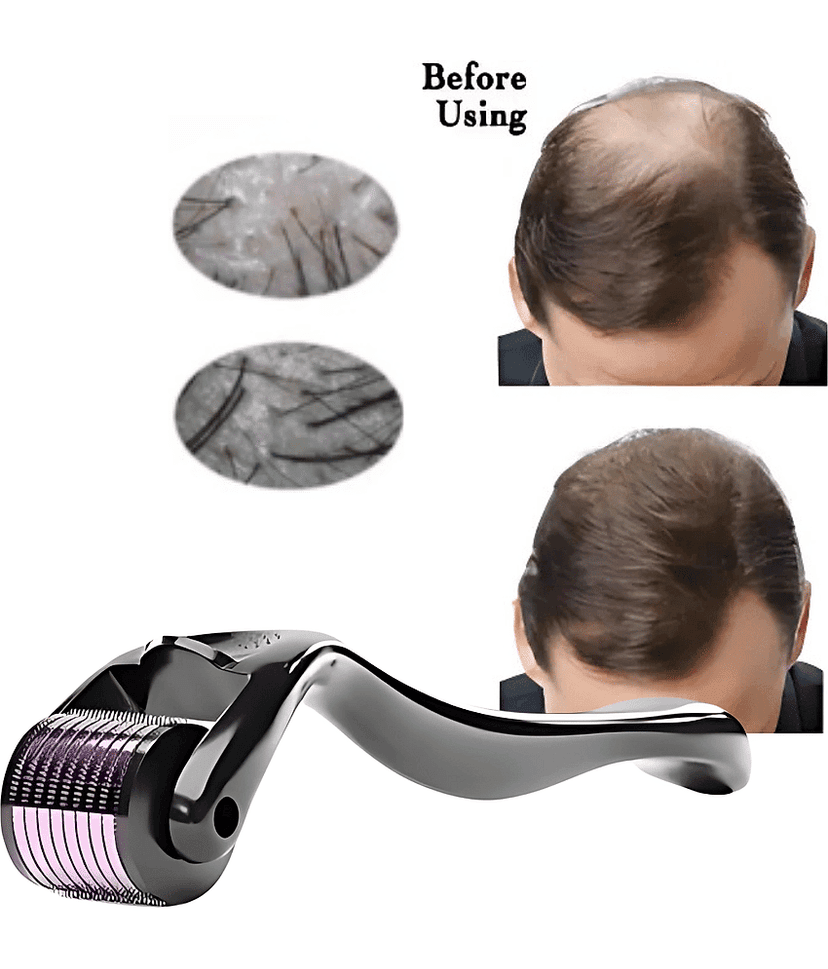 Derma Roller for Hair Growth Wrinkles Face Microdermabrasion | 0.5mm Titanium Alloy 540 Micro Needles For Scalp & Beard